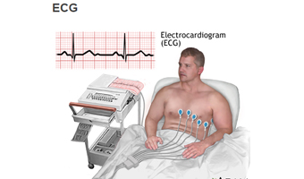 ECG